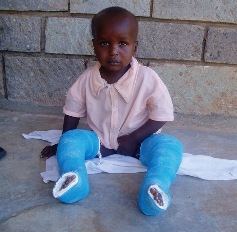 Give a gift that matters: a donation in your friend's name. This gift will provide casts for 5 children born with clubfoot.  For these children, casts mean a cu